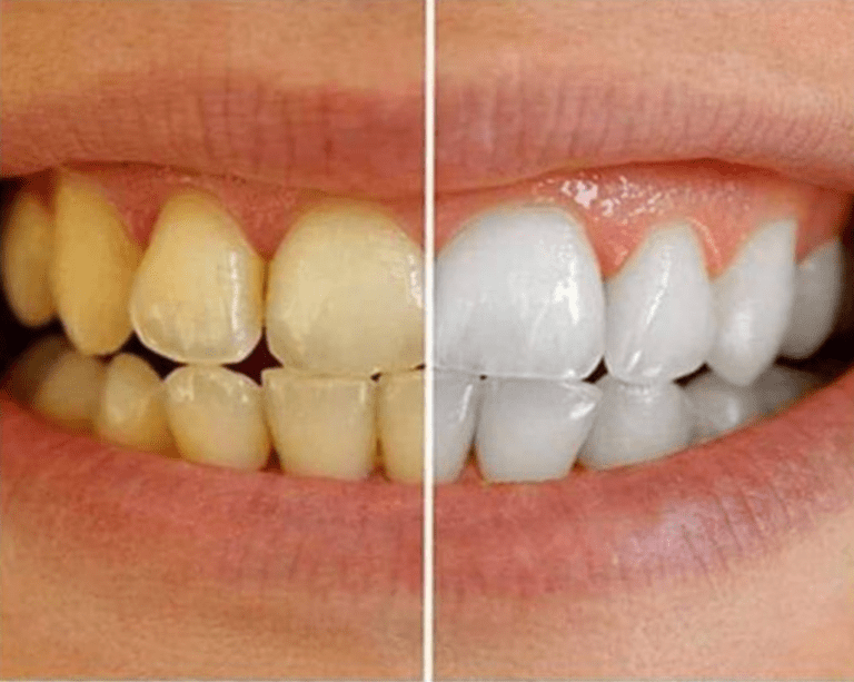 Metodo rapido di sbiancamento dei denti per ottenere un sorriso bianco smagliante