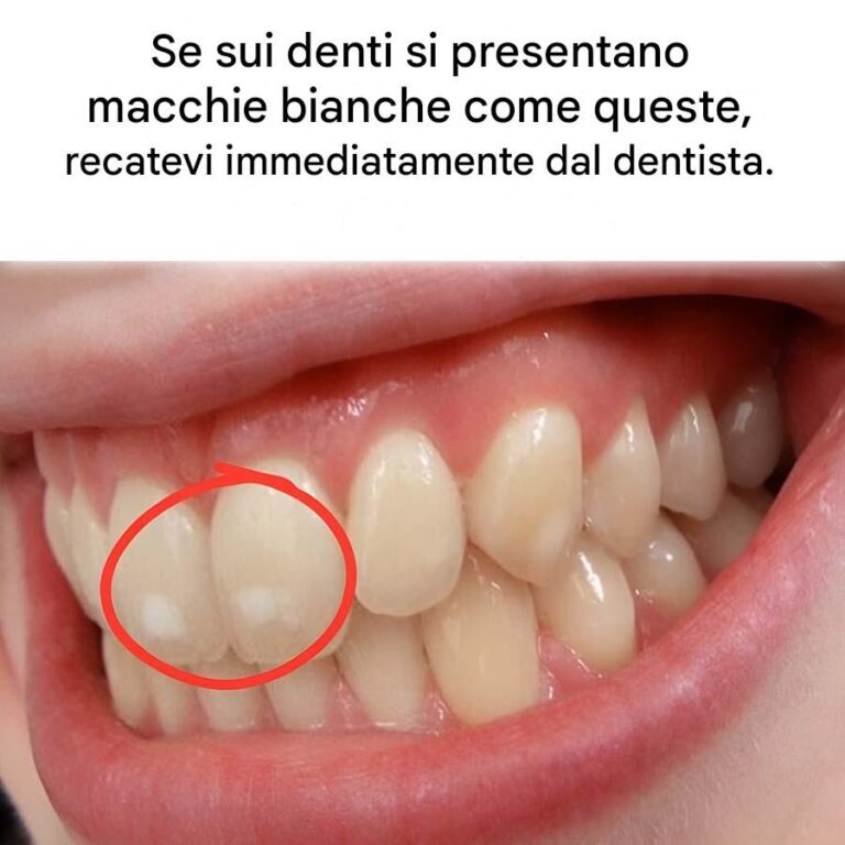 Se i tuoi denti presentano macchie bianche come queste, prendi la situazione sul serio.