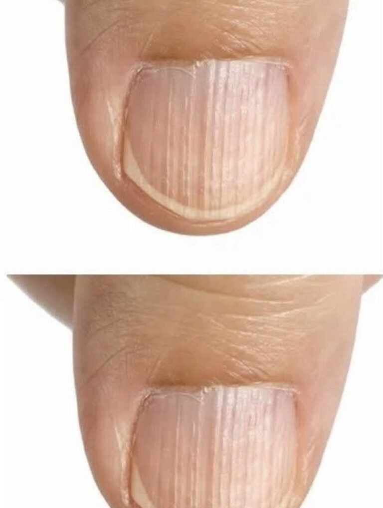 Il dottore spiega cosa significano le creste sulle unghie